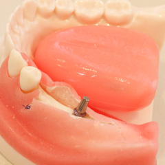歯科用インプラント模型
